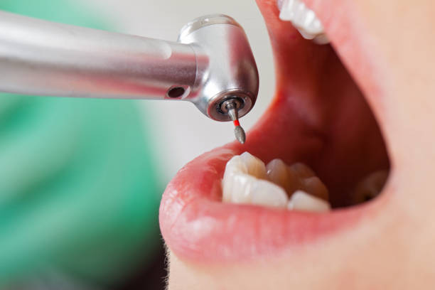 Best Emergency Dental Care for Broken or Chipped Teeth in Devola, OH